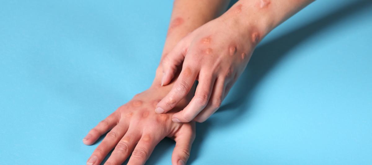 Imagen de archivo de una mujer con el sarpullido que produce el virus mpox.