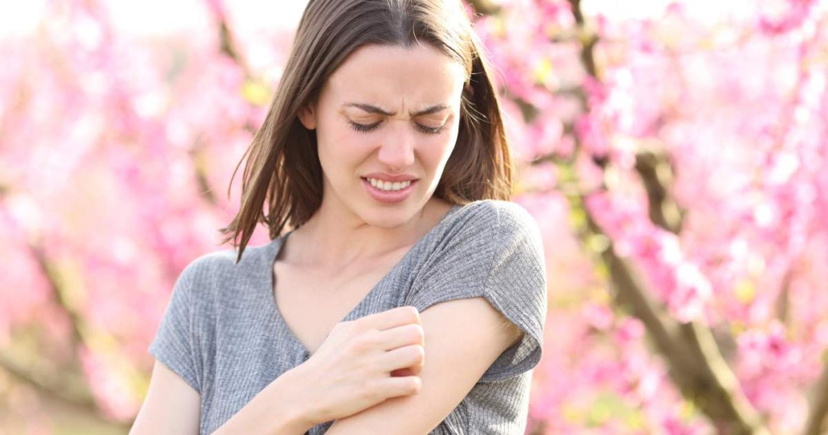 Mujer que acaba de ser picada por un mosquito