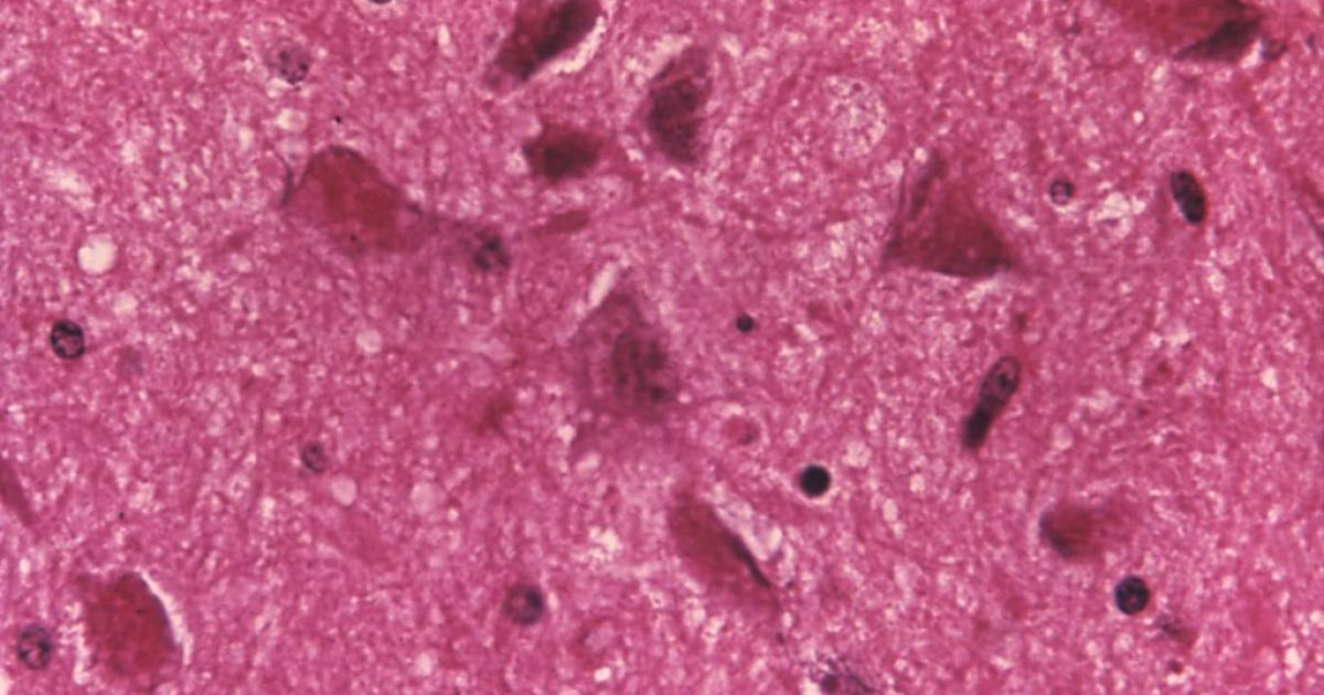 Cambios celulares asociados a la encefalitis de la rabia.