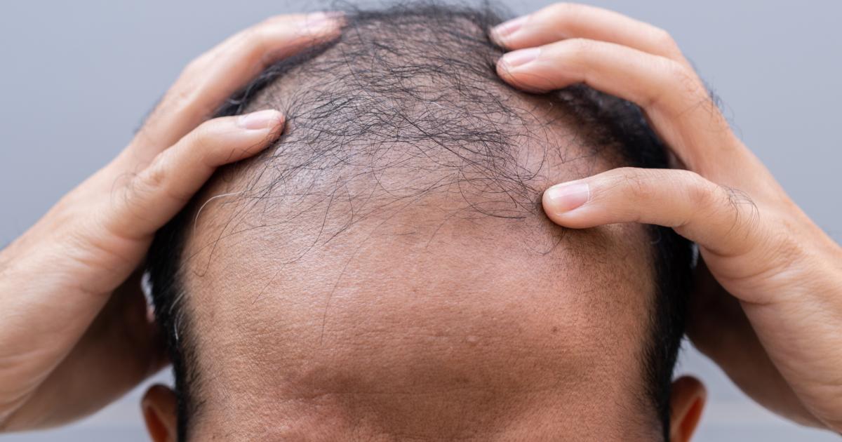 Imagen de archivo de un hombre con problemas de alopecia.