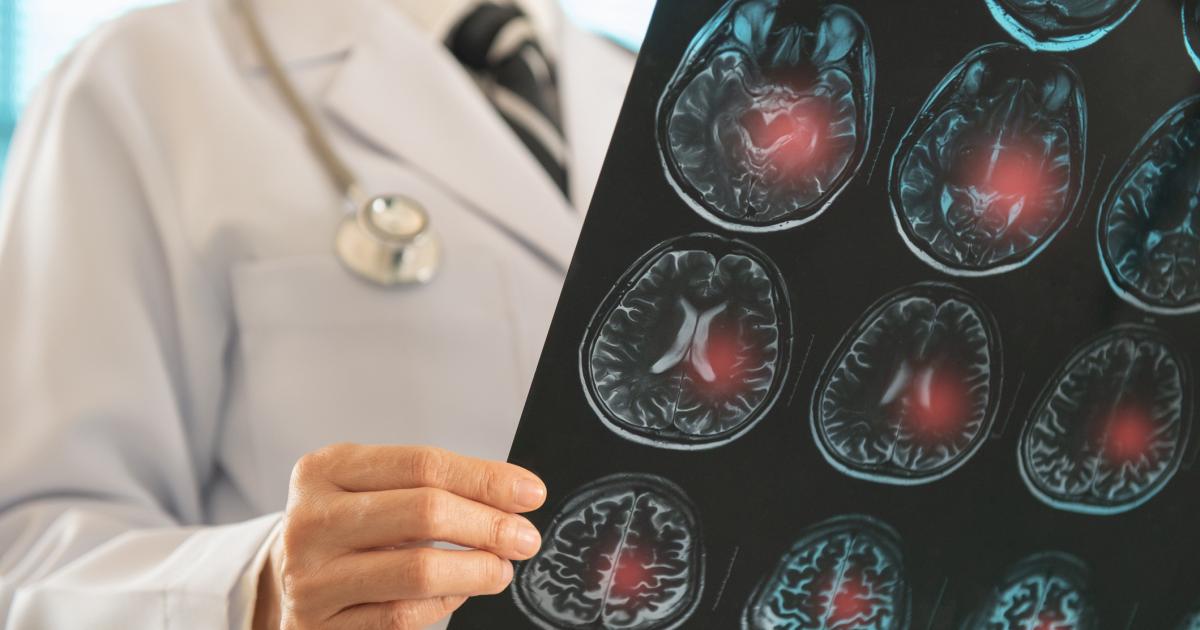 doctor-bueno-sintomas-ictus