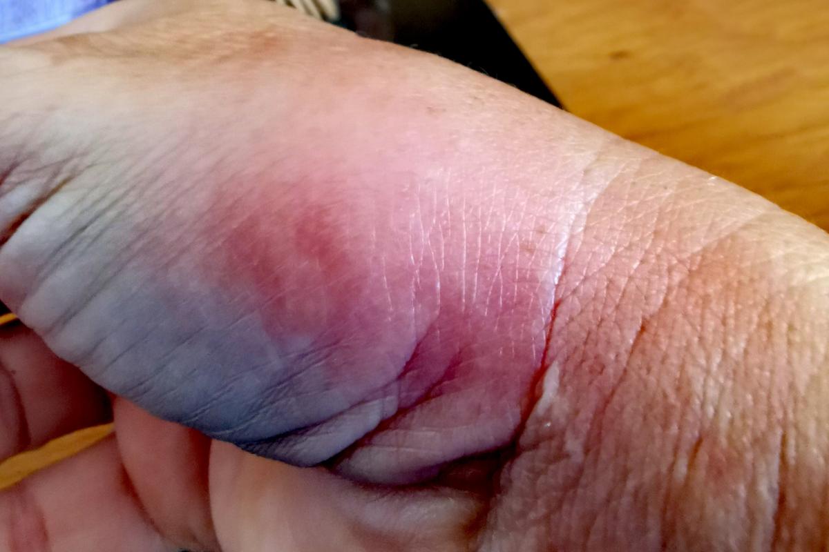 Imagen de archivo de una picadura de mosca negra.