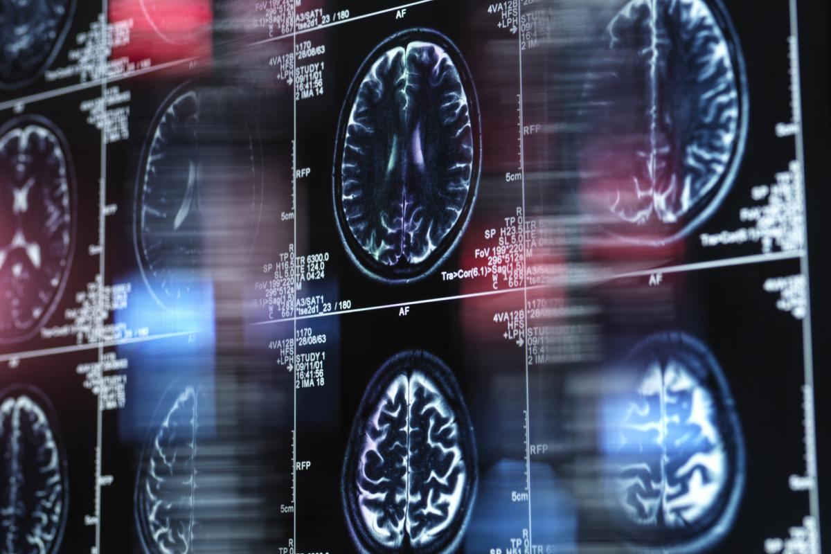 Resonancia magnética de un cerebro humano.