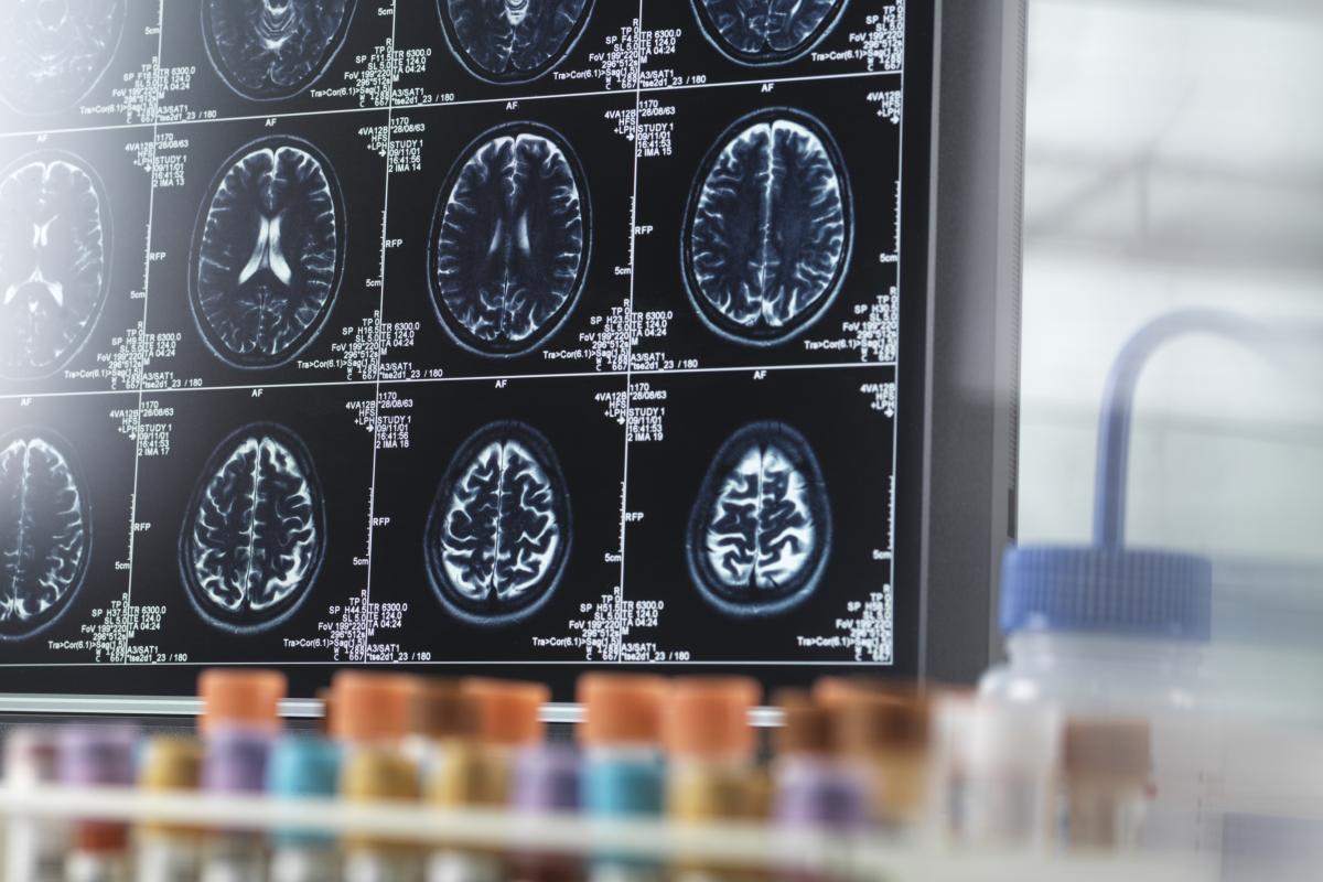 Pruebas del alzheimer.