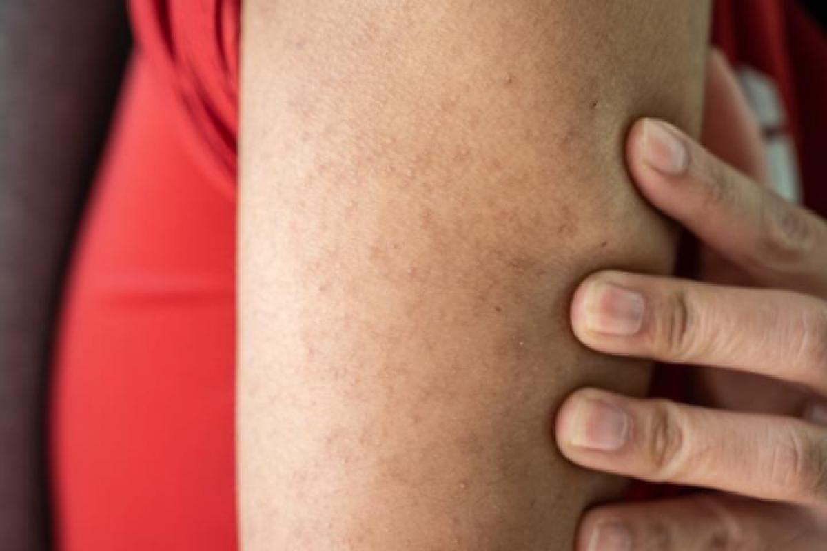 Esta es una solución para eliminar los granitos de los brazos