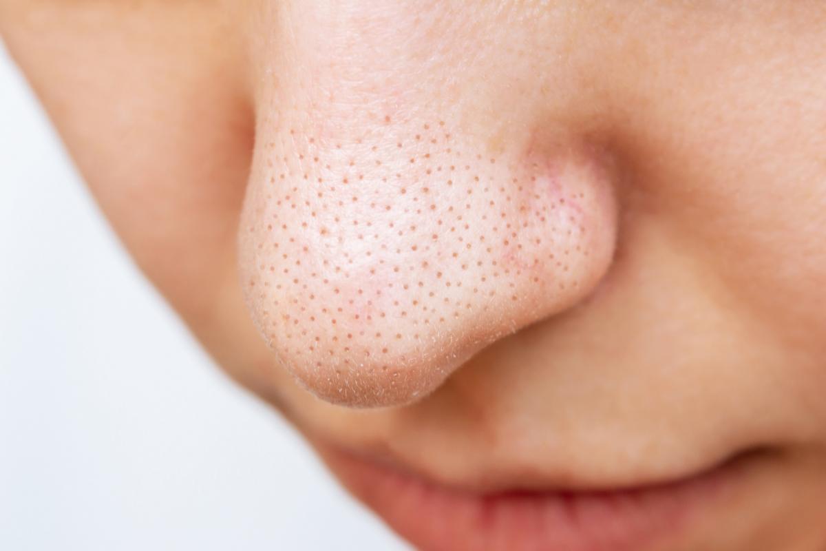 Una nariz con puntos negros.