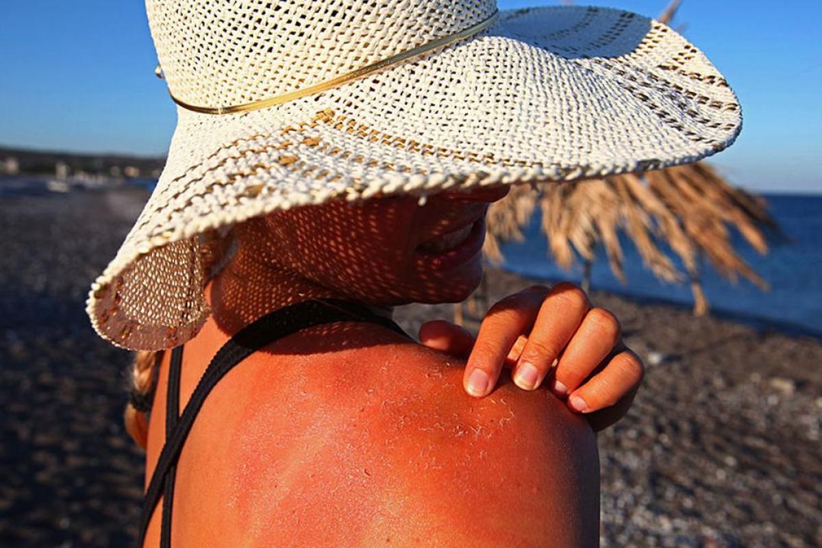 Una chica con la piel quemada en la playa
