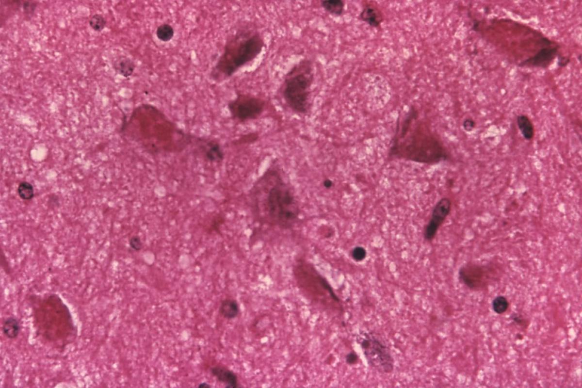 Cambios celulares asociados a la encefalitis de la rabia.