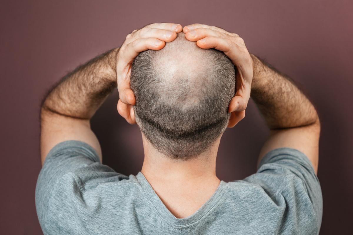 Imagen de archivo de un hombre con alopecia.