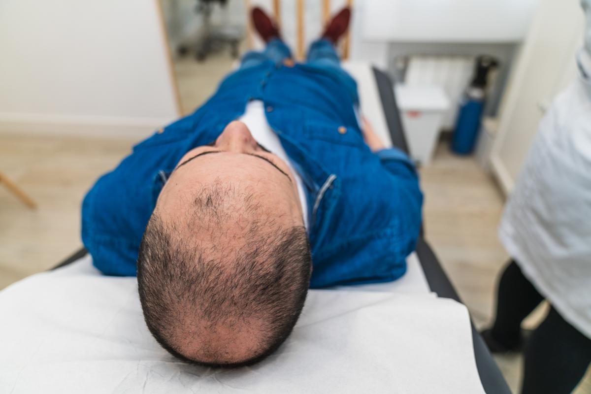 Detalle de primer plano de la cabeza de un hombre con calvicie, acostado sobre una mesa en una clínica de recuperación capilar.