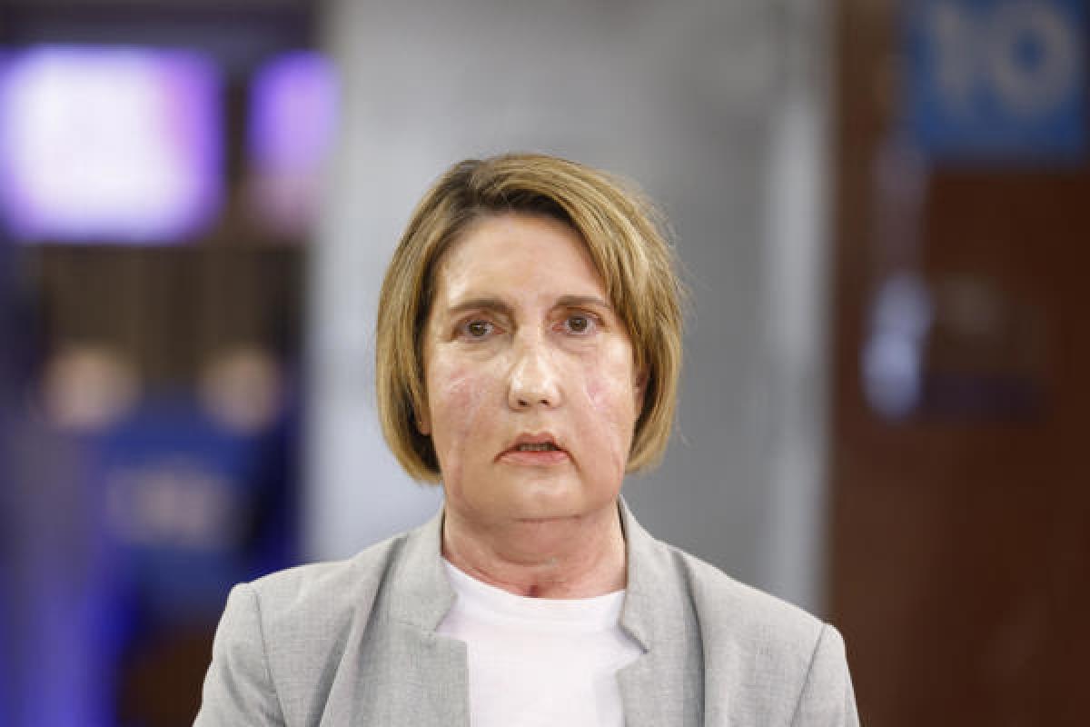 Carme, primera persona en recibir un trasplante de cara de una persona que recibió la eutanasia