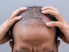 Científicos dan con un prometedor suero con el que se podría decir adiós a la calvicie