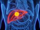 Investigadores españoles identifican dos proteínas vinculadas con el crecimiento del cáncer pediátrico hepatoblastoma