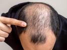 España es el país con mayor porcentaje de hombres calvos del mundo