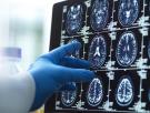 Investigadores británicos identifican seis síntomas depresivos en la mediana edad que aumentan hasta un 50% el riesgo de demencia