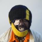 Mohamed, un nativo de la ciudad de Conakry, en Guinea, muestra sus heridas que atribuye a la actuación de la policía marroquí en Nador el pasado junio.