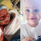 "Elliott nació con ocho semanas de antelación (a las 32 semanas), después de que rompiera aguas a las 28 semanas. Pesó 1,45 kilos y midió 41 centímetros. Tuvo que estar seis semanas en la UCIN y volvió a casa teniendo que respirar con una...