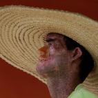 Al oeste de Brasil, se encuentra la concentraci&oacute;n m&aacute;s grande de personas que padecen de una extra&ntilde;a condici&oacute;n cong&eacute;nita llamada xerodermia pigmentosa, tambi&eacute;n conocida como &quot;XP&quot;. En esta condic...