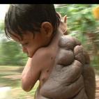 Didier Montalvo, un niño colombiano de seis años, nació con la condición nevus melanocítico, un padecimiento que a simple vista muestra sobre todo su cuerpo, múltiples lunares. A diferencia de otros casos, Didier tenía un lunar gigantesco...