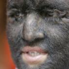 Larry Ramos Gomez, "El niño lobo" de México, sufre de una extraña condición llamada hipertricosis congénita generalizada, que cubre su rostro y otras partes del cuerpo con una cantidad excesiva de cabello.