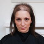 Robina Hutchings sufre de tricotilomanía, un desorden que se caracteriza por un incontrolable deseo de arrancarse el cabello. La mujer inglesa le dijo al Daily Mail de Londres, que comenzó a arrancarse el cabello cuando tenía 11 años, y 27 a...