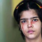 Las escuelas le han negado el acceso y algunos habitantes de su villa en la India, dicen que está maldita. Twinkle Dwivedi, quien al momento de esta foto tenía 13 años de edad, sangra por la piel, sin haber sufrido ningún rasguño o herida, ...