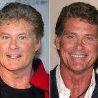 El eterno vigilante de la playa explicó a la revista People en 2006: "Me he puesto bótox, todo el mundo se lo ha puesto", contaba Hasselhoff. "Es un subidón. Te quita la marca del ceño fruncido, no lo he tenido en un año. Me enorgullece. Es...