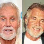 El actor estadounidense y cantante de música country se ha hecho un lifting para tratar de parecer más joven. Algunos doctores también apuntan a un levantamiento de ojos y a inyecciones de bótox.