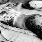 Un herido, atendido en la base de Ninoshima Island.