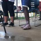 MSF opera en Bajo Chiquito de la mano del Ministerio de Salud y tambi&eacute;n atiende a los miembros de la comunidad local. La mayor&iacute;a de las patolog&iacute;as presentadas por los pacientes son producto de d&iacute;as caminando en una se...