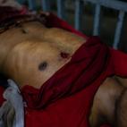 Agujeros de bala en el pecho de uno de los manifestantes.