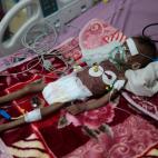 Rahmah Watheeq, una ni&ntilde;a malnutrida, es asistida en un hospital de Sanaa, Yemen, el 3 de noviembre.