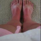 Chanclas traicioneras: un clásico muy doloroso de quemadura solar