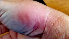 Imagen de archivo de una picadura de mosca negra.