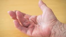 Una persona con la enfermedad Dupuytren.