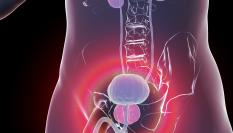 Ilustración de un cáncer de próstata.