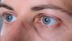 Algunas enfermedades empeoran las molestas moscas de los ojos.