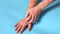 Imagen de archivo de una mujer con el sarpullido que produce el virus mpox.