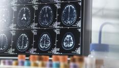 Pruebas del alzheimer.