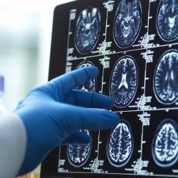 Investigadores británicos identifican seis síntomas depresivos en la mediana edad que aumentan hasta un 50% el riesgo de demencia