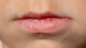 Jerónimo, experto farmacéutico, sobre cómo proteger los labios del frío: "Hay una planta especialmente potente, 'la sangre de dragón"