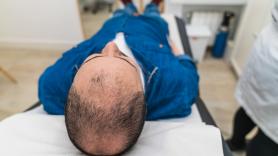 Un joven se somete a un trasplante capilar y los resultados dejan mucho que desear: "Después de dos días, parecía Megamind"