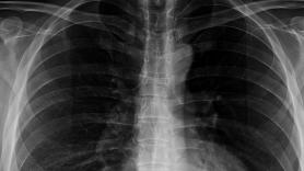 "Sentía cómo se movía entre mis costillas": acaba en urgencias tras tragarse una cuchara de 17 centímetros entera