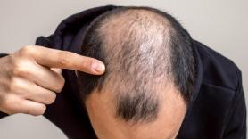 España es el país con mayor porcentaje de hombres calvos del mundo