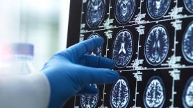 Investigadores británicos identifican seis síntomas depresivos en la mediana edad que aumentan hasta un 50% el riesgo de demencia