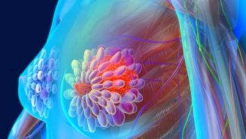 Identifican la leche materna como posible herramienta para diagnosticar el cáncer de mama