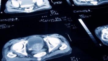 Un análisis de sangre permitiría diagnosticar el cáncer de próstata