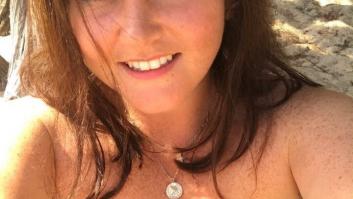 Tengo alopecia y esto es lo que me gustaría que supieran mis amigos