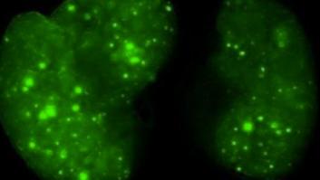 Los tumores eligen a qué órgano irá la metástasis y preparan el terreno