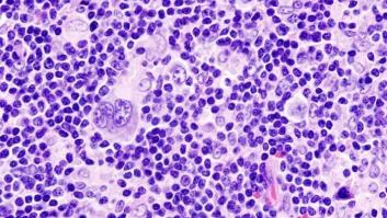 Qué es el linfoma de Hodgkin, el cáncer de Dani Rovira y Carla Suárez